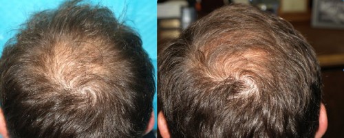 Male patient before and after ACell hair loss treatment