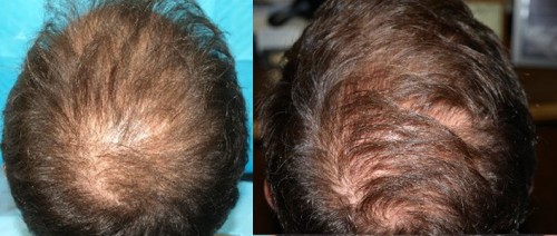 26-Year-Old Male Patient Before and after ECM+Saline Treatment