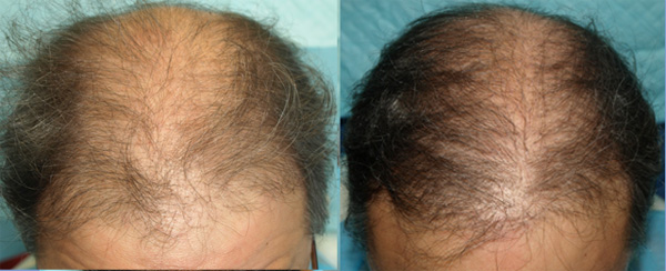 52-Year-Old Male Patient Before and After ACell PRP hair loss Treatment