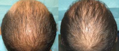 Acell + PRP Injections Before and After results on 29 years old male patient