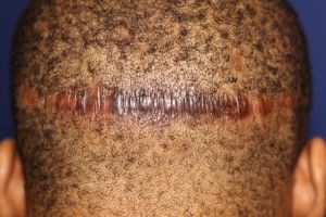 scar on donor area after hair transplant
