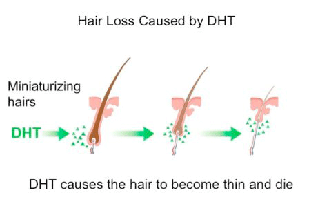 DHT causing hair to thin illustration