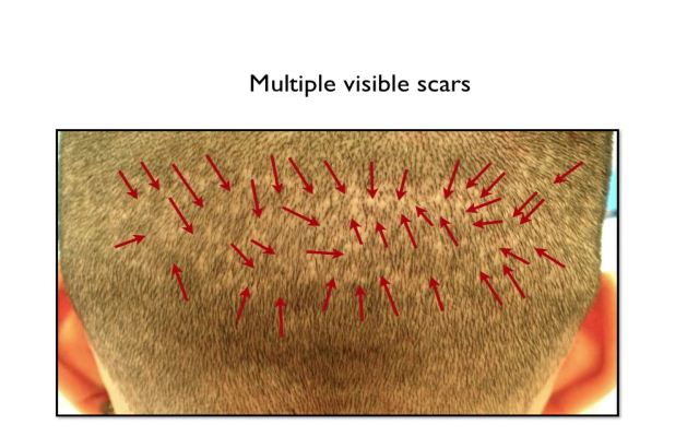 FUE multiple scars on head