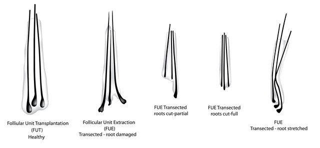 FUT FUE healthy and unhealthy hair strands illustration