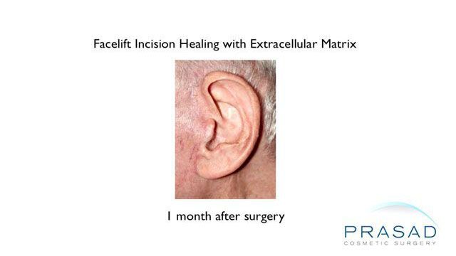 facelift incision healing with ECM 1 month after surgery