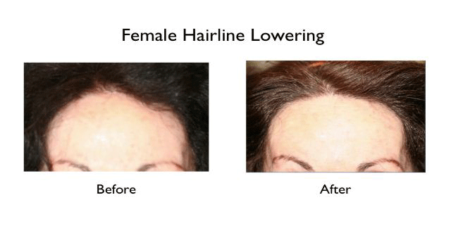 patient with female hairline lowering