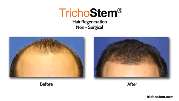 male hair thinning treated with hair regeneration - before and after treatment results