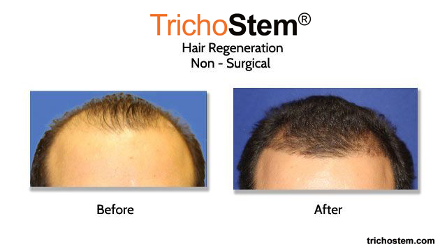 before and after TrichoStem™ Hair Regeneration treatment for male hair thinning