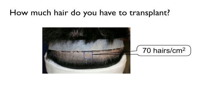 hair transplant donor area