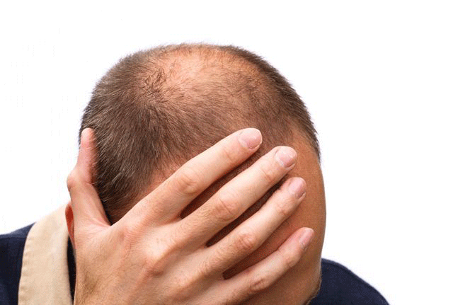 Hair Fall Reasons in Male