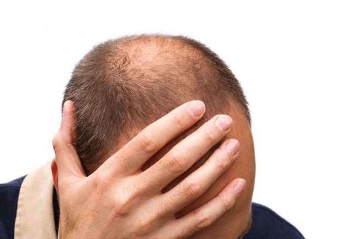Main Causes Hair Loss In Men and How to Treat | TrichoStem® Main Causes Hair Loss In Men and How to Treat | TrichoStem®
