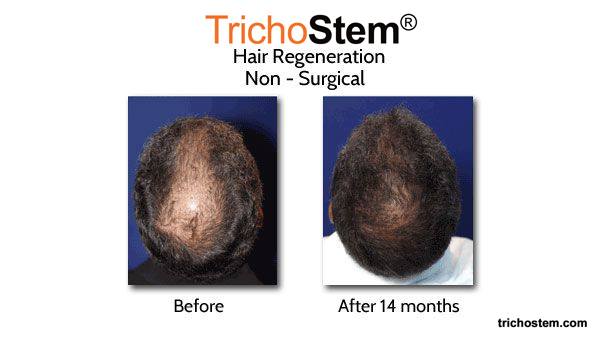 before and 14 months after Hair Regeneration PRP+ACell single treatment on male patient