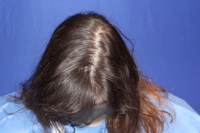 patient with female pattern hairloss