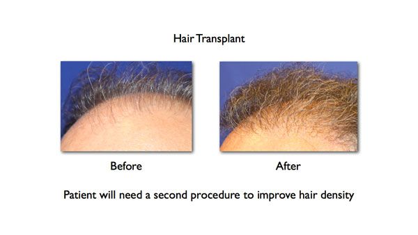 before and after hair transplant with poor hair density results