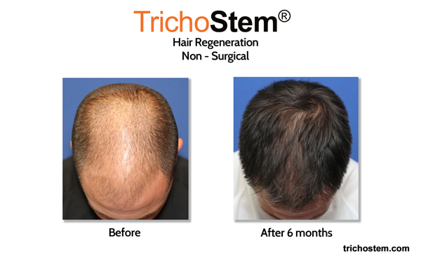 TrichoStem™ Hair Regeneration VS Other Hair Restoration
