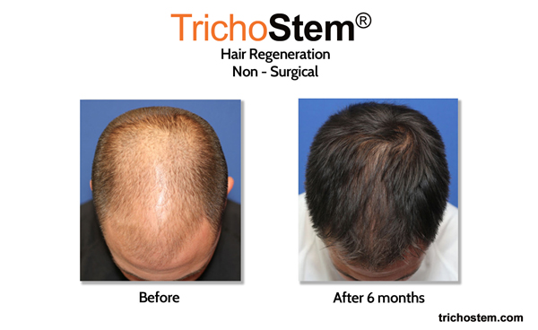 before and after trichostem hair regeneration - a hair transplant alternative for male hair thinning