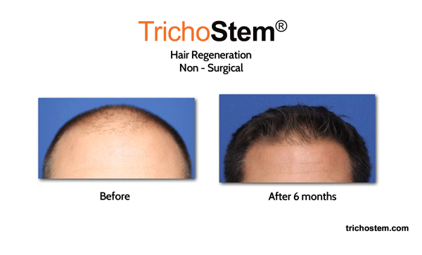 Hair Regeneration PRP+ACell patient of Dr. Amiya Prasad - before and after treatment results