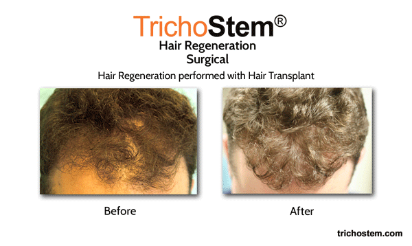 Hair Regeneration performed with Hair Transplant for hair loss problem solution - before and after treatment results