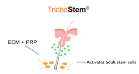 the trichostem procedure illustration