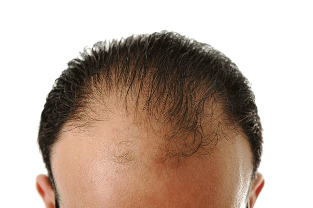 11 Common Signs of Male Pattern Baldness in Men