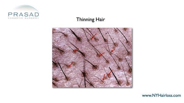 microscope-images-of-hair-thinning