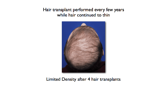 male patient has poor hair density after several hair transplants