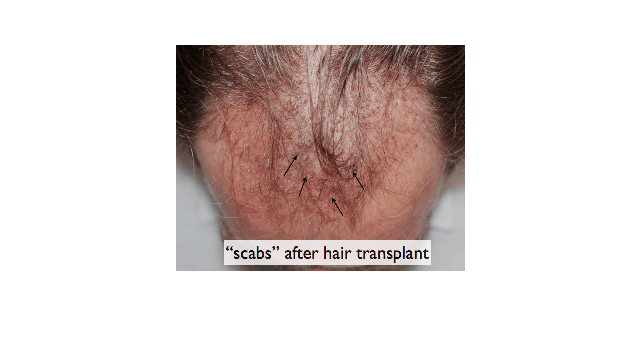 Temporary scabbing after a hair transplant.