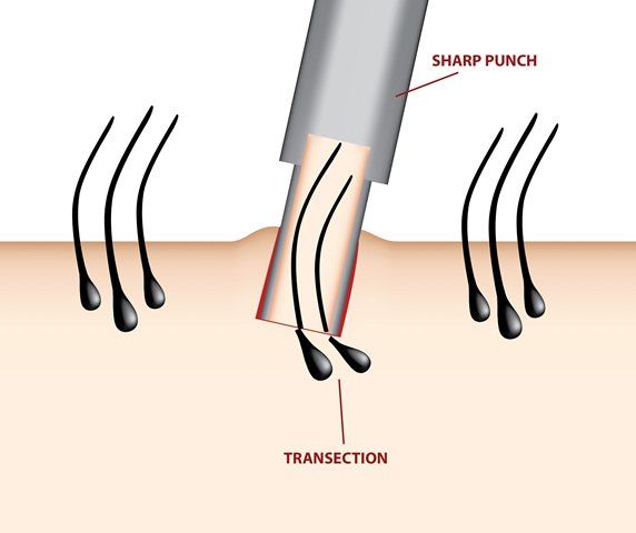 FUE method of hair transplant illustration