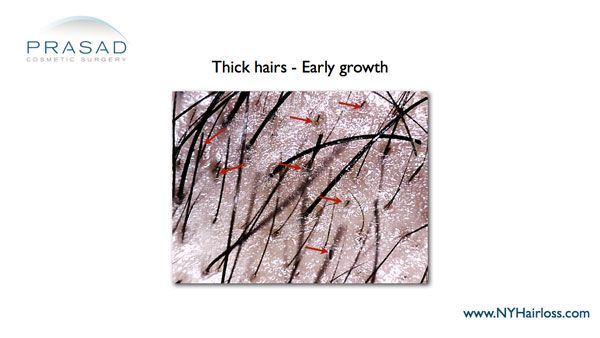 thick-hairs-early-growth-from-hair-regeneration microscope image