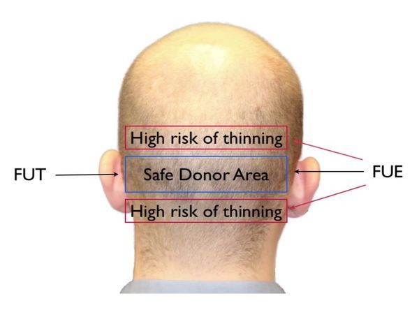 FUT vs FUE donor area illustration