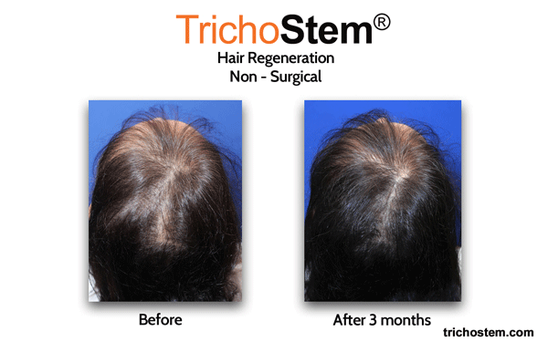 before and after TrichoStem® Hair Regeneration treatment results for female hair thinning
