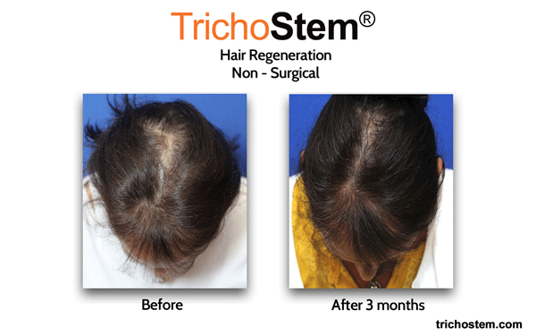 before and 3 months after TrichoStem Hair Regeneration treatment hair loss in women