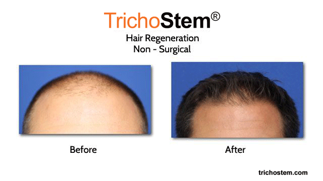 before and after TRICHOSTEM™ HAIR REGENERATION treatment for male hair thinning