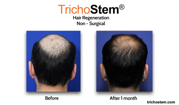 Before and after TrichoStem® Hair Regeneration. After photo shows Visible results on crown area of male patient 1 month after the treatment 