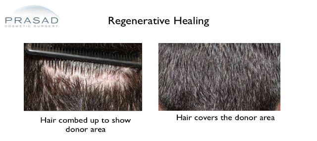 donor area regenerative healing