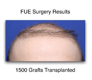 FUE surgery results frontal hairline