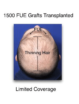 FUE grafts top of head