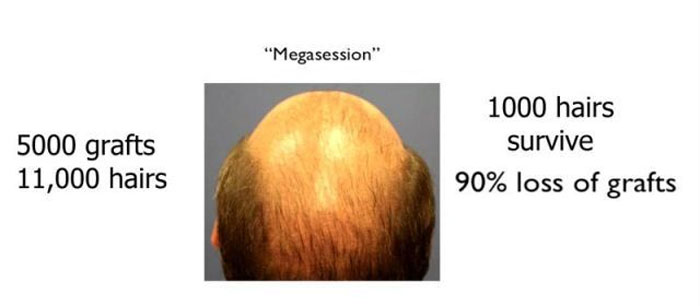 Hair Transplant Alternative that Also Benefits Hair Transplants |TrichoStem Hair Transplant Alternative that Also Benefits Hair Transplants |TrichoStem