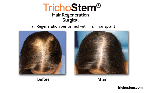 hair tranplant plus hair regeneration on female patient - before and after result