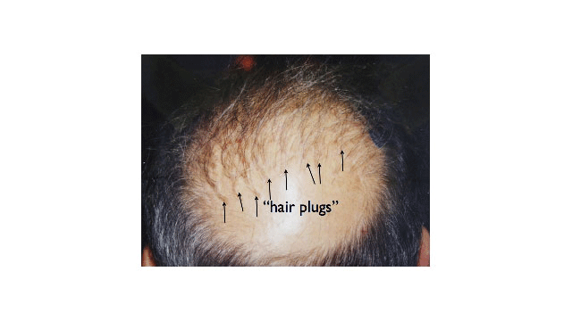 visible pluggy look on crown area of the head