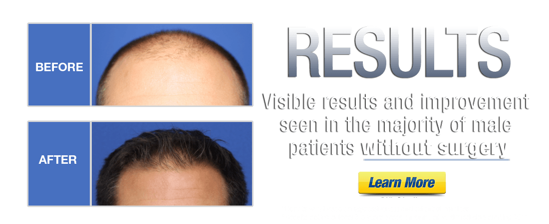 14+ Non Surgical Hair Loss Naperville Images