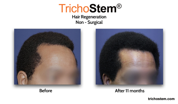 before and 11 months after Trichostem results