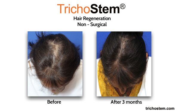 female pattern hair loss treated with Trichostem Hair Regeneration