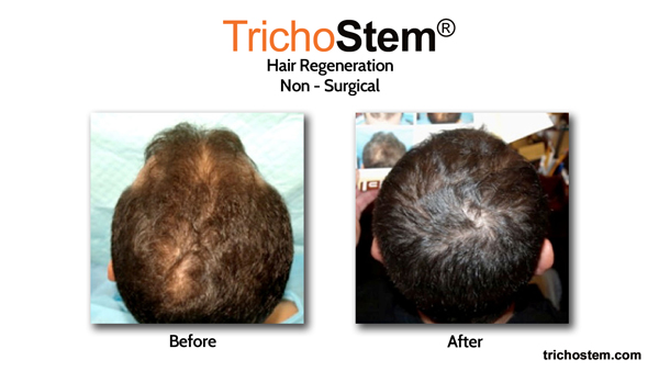 Before and After Trichostem® Treatment