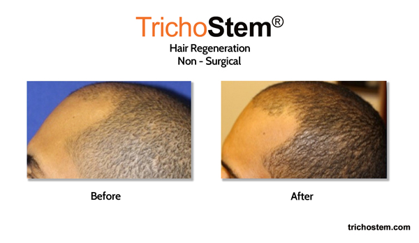 visible hair regrowth after Trichostem Hair Regeneration treatment