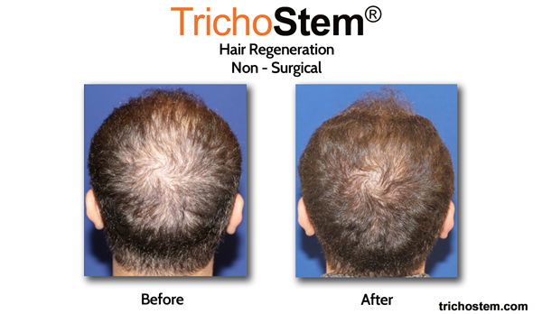 before and after hair regeneration treatment