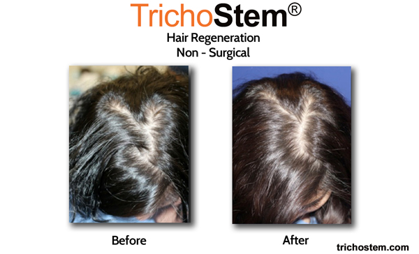 before and after result of Trichostem on women
