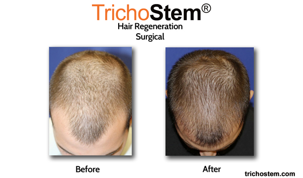 before and after Trichostem treatment