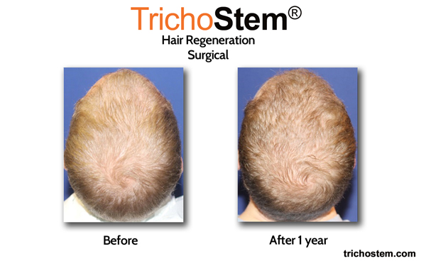 male pattern baldness cured with Trichostem treatment