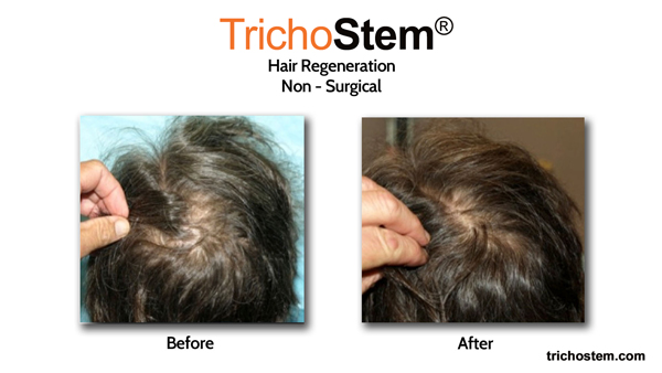 before and after hair loss treatment